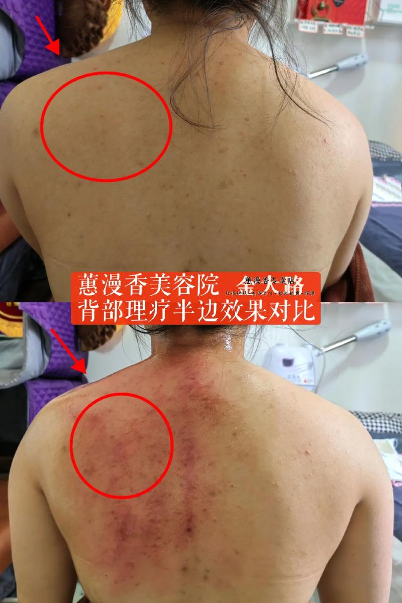 肩颈理疗